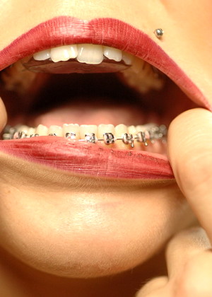 Beautyandbraces Model